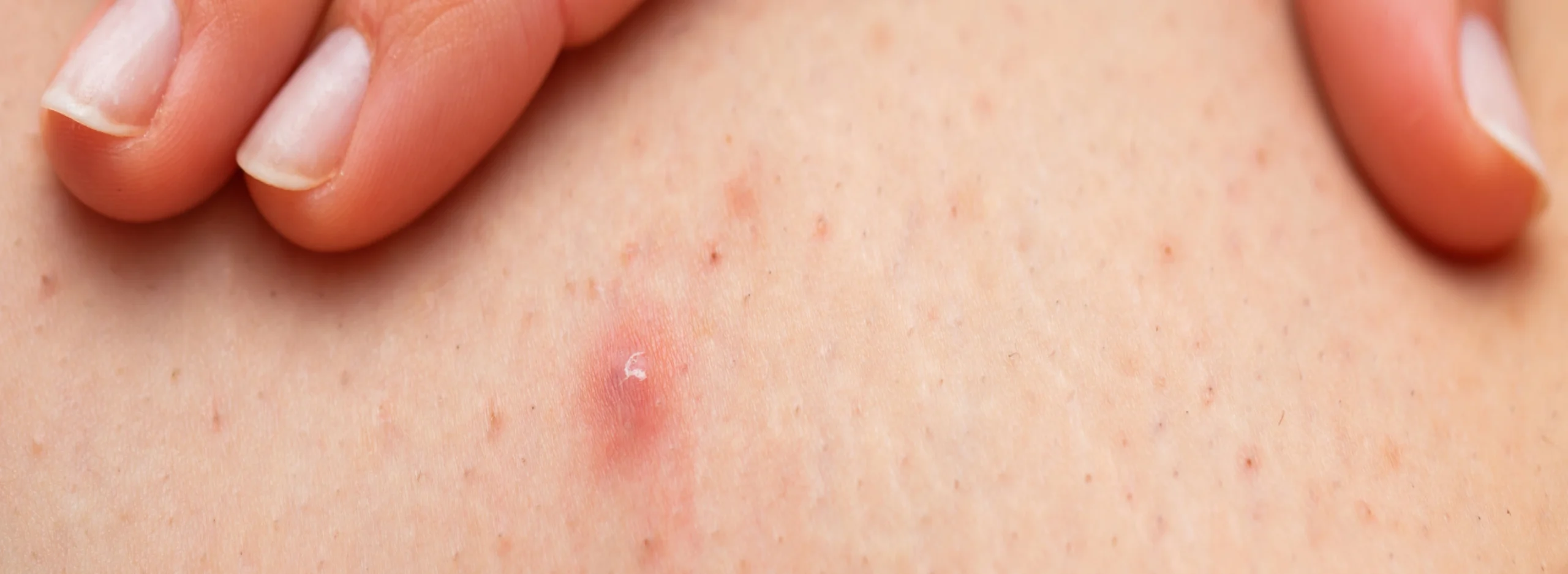 How to treat folliculitis after waxing - buyitalwax.com